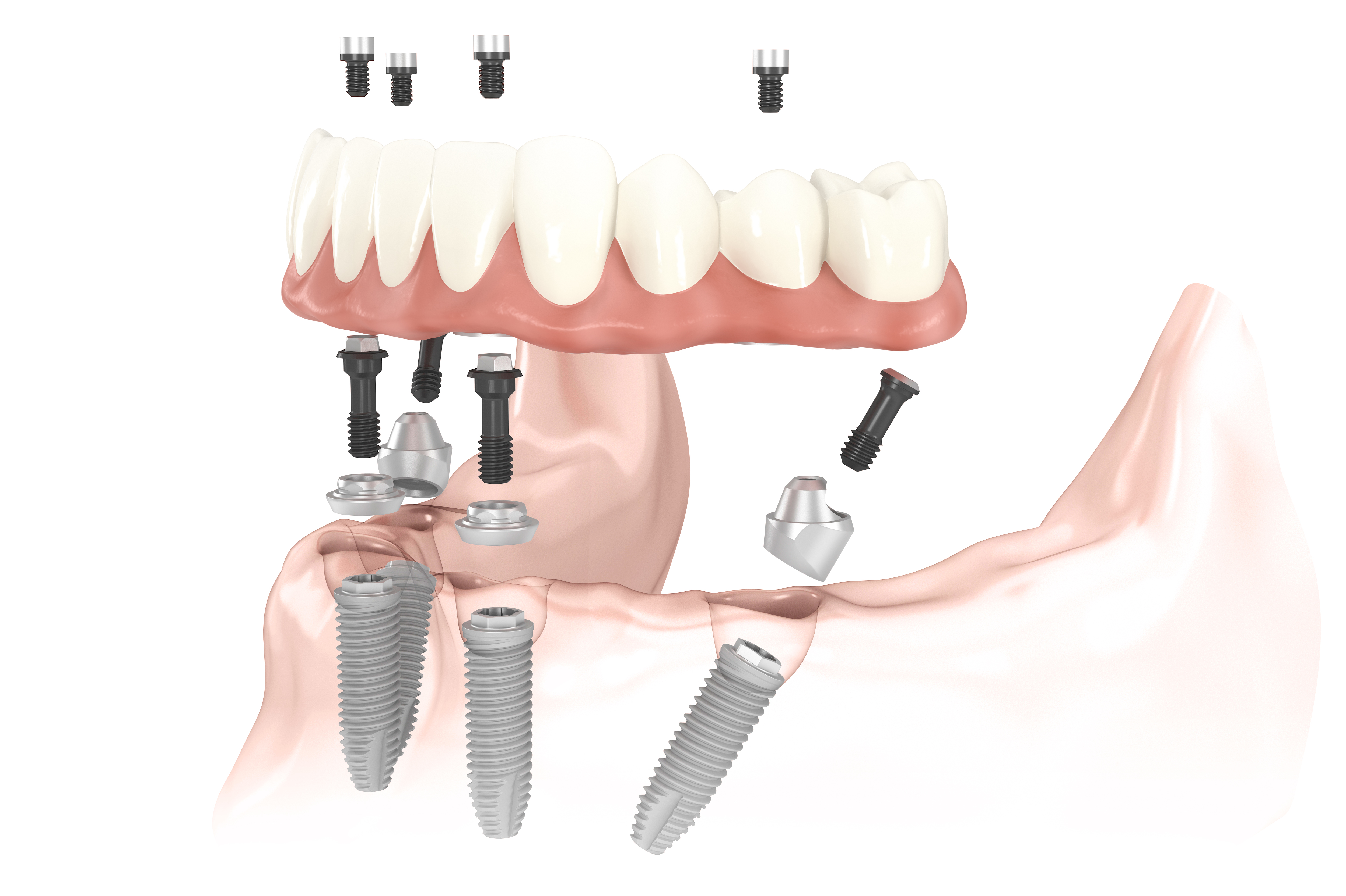 Протезирование зубов в казани. Nobel Biocare имплантаты all on 4.